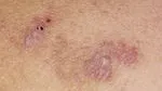 Lihen Planus