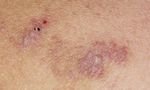 lihen planus