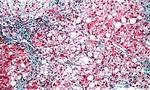 steatohepatitis