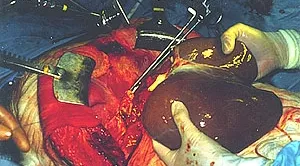 Transplantacija Jetre